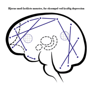 hvordan opstår depression. Hver gang du, bevidst eller ubevidst, vælger at se på den negative side af en sag, så opstår der et spor i hjernen, som bliver til et fastlåst mønster, når du har gjort det tilstrækkeligt mange gange hvordan opstår depression. Hver gang du, bevidst eller ubevidst, vælger at se på den negative side af en sag, så opstår der et spor i hjernen, som bliver til et fastlåst mønster, når du har gjort det tilstrækkeligt mange gange